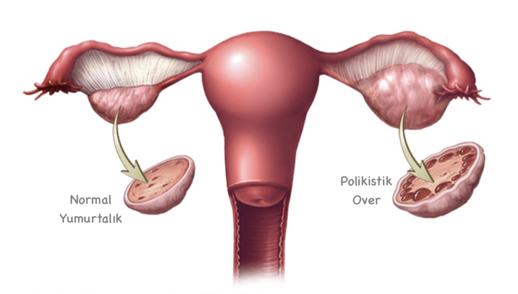 Ankara Polikistik Over Sendromu