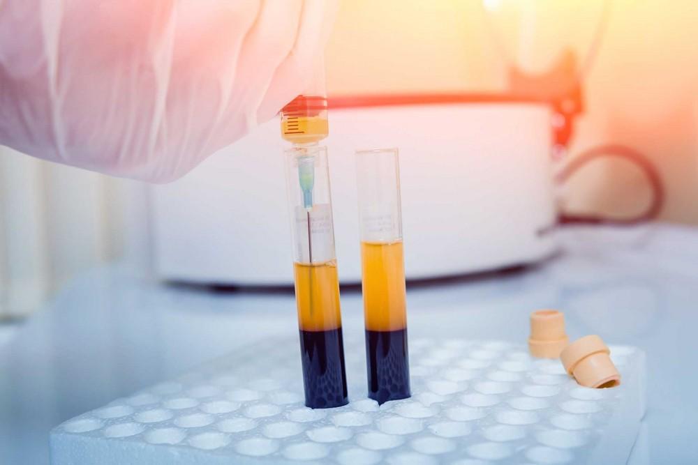 Genital PRP Ankara